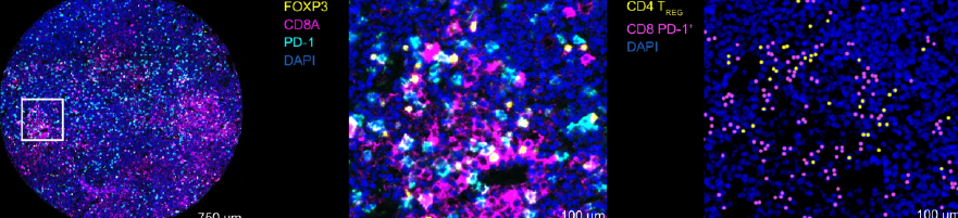 Integrative multi-omics reveals a regulatory and exhausted T-cell landscape in CLL